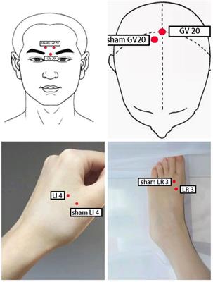 Electroacupuncture versus Escitalopram for mild to moderate Post-Stroke Depression: A randomized non-inferiority trial